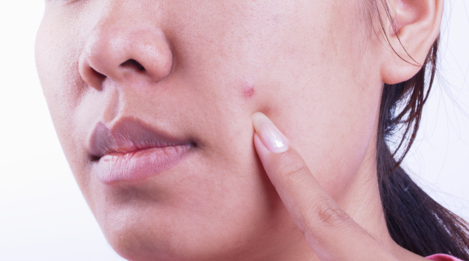 what-skin-cancer-looks-like-a-pimple-skin-cancer-warning-arcadia